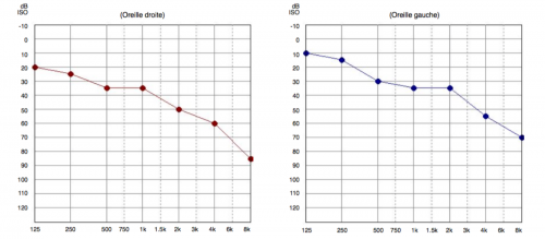 audiogramme de la presbyacousie trouble auditif lié à l'âge