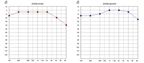 audiogramme d'une presbyacousie, perte auditive liée à l'âge, presbyacousie def, causes et conséquences de la presbyacousie