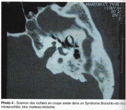 surdité de l'enfant, syndrome branchio oto rénal, scanner des rochers