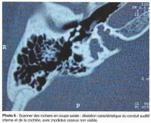 conduit auditif interne et cochlée, erte auditive et surdité chez l'enfant