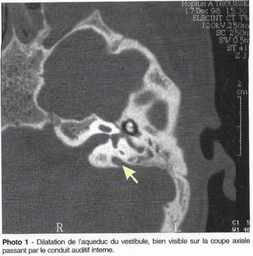 surdité chez l'enfant et syndrome de pendred