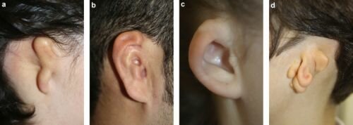 surdité de transmission, malformation de l'oreille